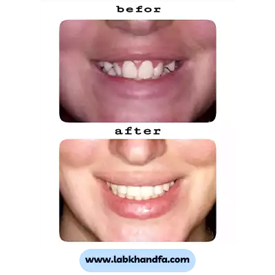 نمونه کار ارتودنسی دکتر مهسان مقیمی