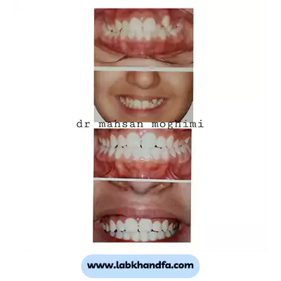 نمونه کار ارتودنسی کودکان دکتر مهسان مقیمی