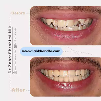 نمونه کار اصلاح ناهنجاری های دهانی دکتر زهرا ابراهیمی نیک