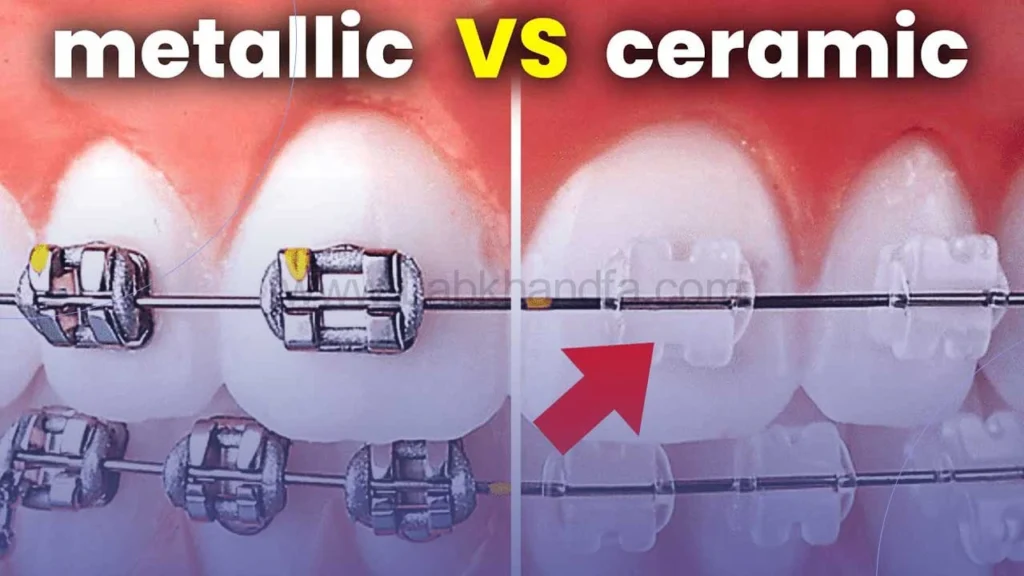 انواع ارتودنسی ثابت