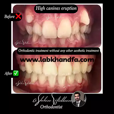 قبل و بعد نمونه کار درمان ارتودنسی دکتر شهریار افتخاریان