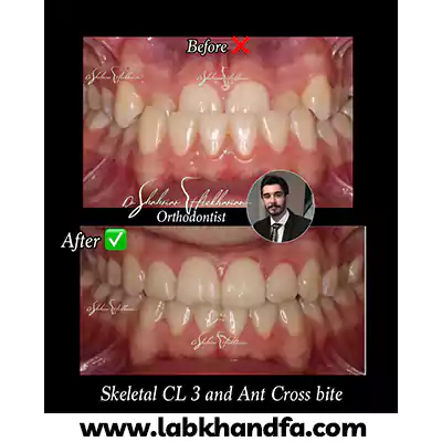 نمونه کار دیگری از درمان ارتودنسی توسط دکتر شهریار افتخاریان