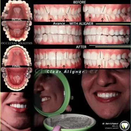 نمونه کارهای درمان ارتودنسی با الاینرهای شفاف