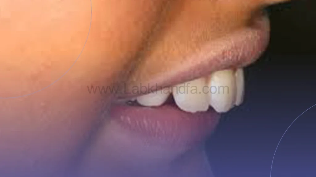 دندان خرگوشی کودکان