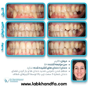 عکس قبل و بعد ارتودنسی نامرئی توسط دکتر هادی درویش پور