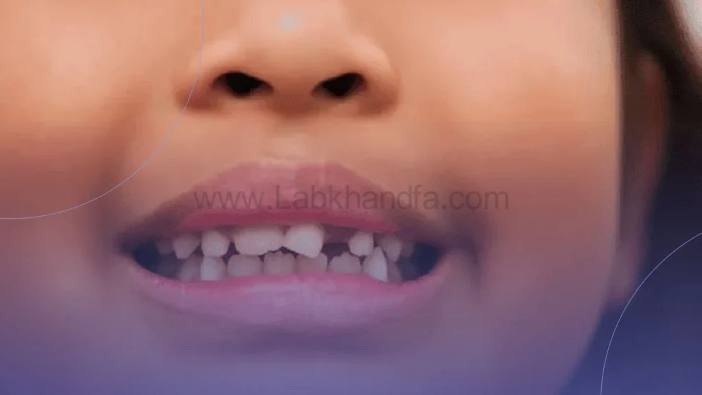 نامرتبی دندان کودکان