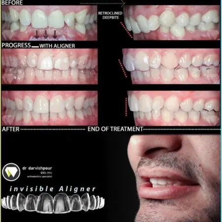 نمونه کارهای درمان ارتودنسی با الاینرهای شفاف