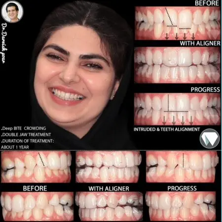 نمونه کارهای درمان ارتودنسی با الاینرهای شفاف