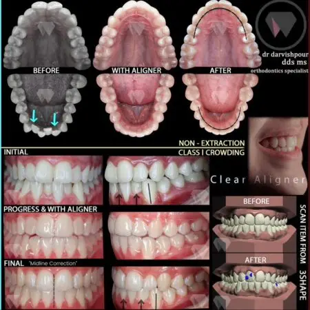 نمونه کارهای درمان ارتودنسی با الاینرهای شفاف