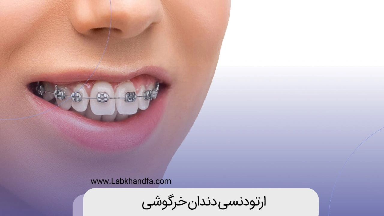 ارتودنسی دندان خرگوشی